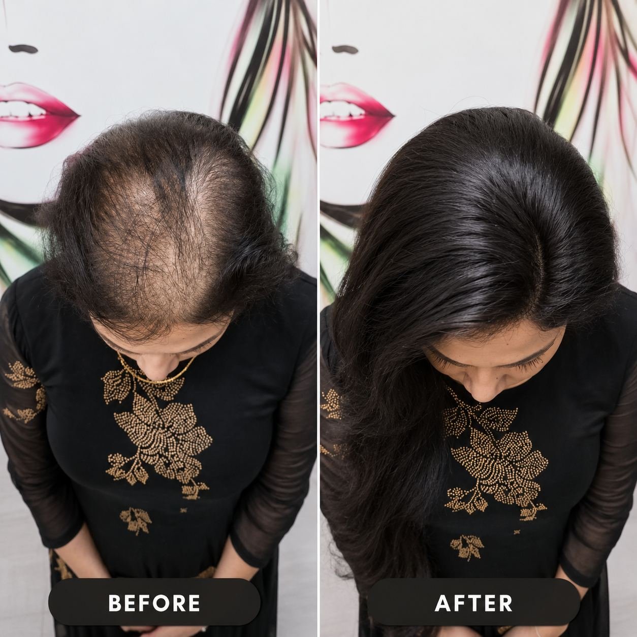 Before and after — crown coverage